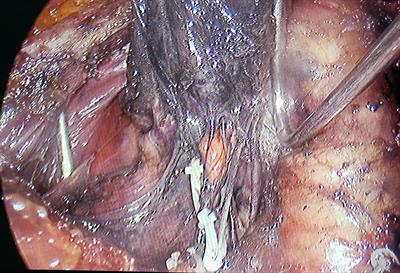 Clinical application of parathyroid autotransplantation in endoscopic radical resection of thyroid carcinoma